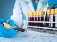 DƏHŞƏT! Yeni virus qapıda: 155 nəfər qəfildən keçəl oldu